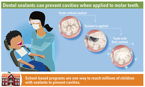 Dental Sealants